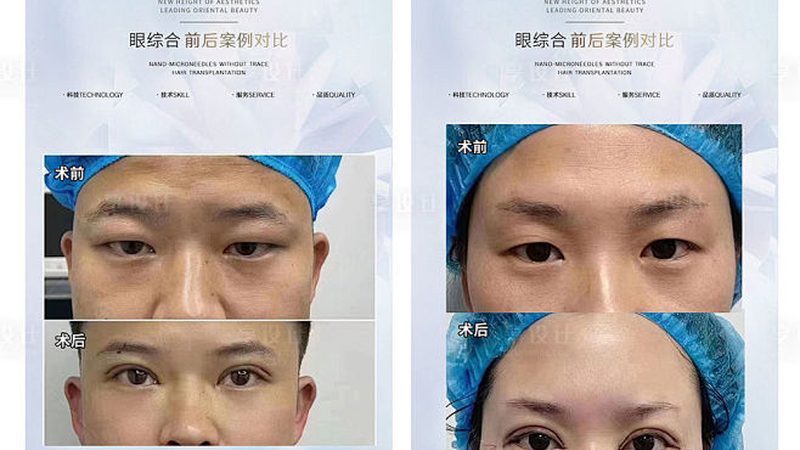 厦门双眼皮修复：揭秘适合哪些人群**