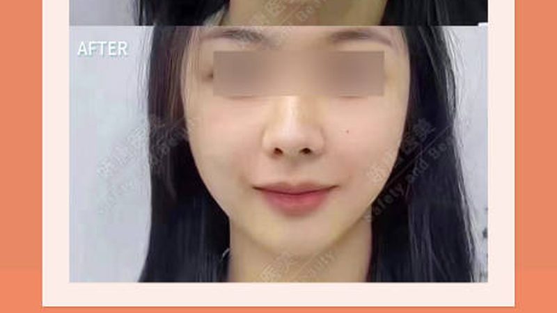 瘦脸针价格揭秘：北京正规医院如何选择？**