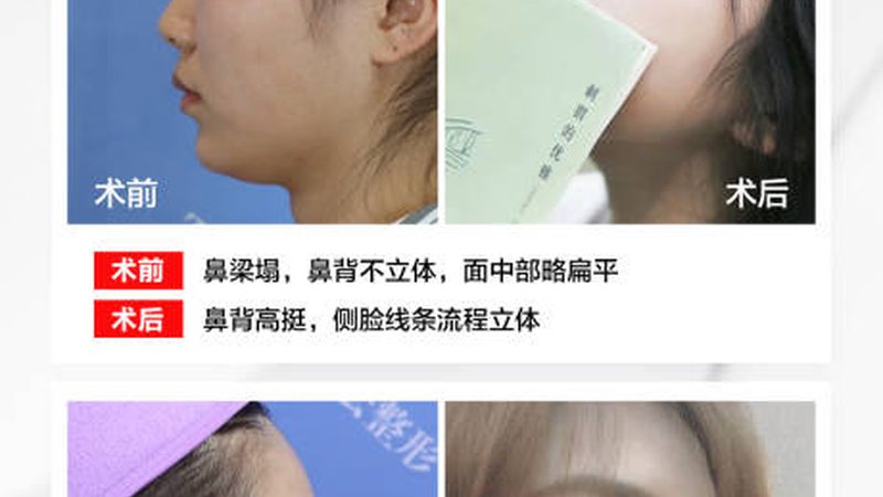 医美整形失败案例，揭秘行业真实面