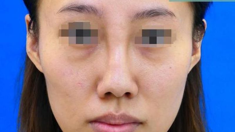 瘦脸贴片适合以下人群使用：